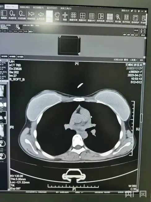 一张CT片子套多个病历！医生实名举报无锡虹桥医院涉嫌骗保→