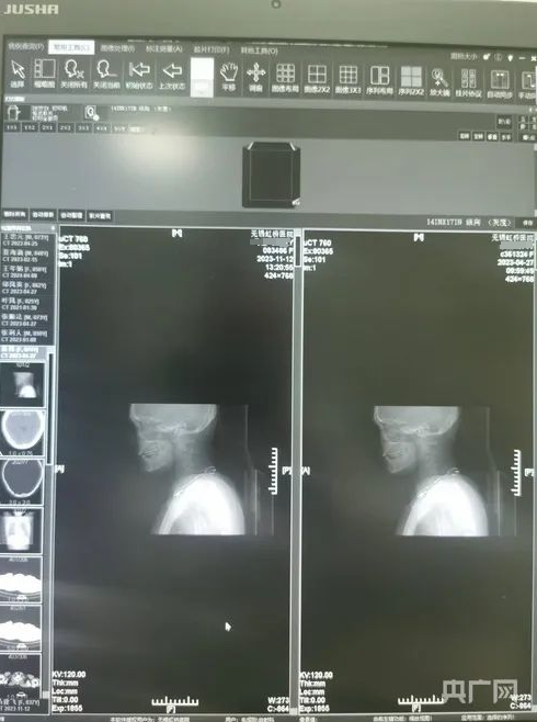 一张CT片子套多个病历！医生实名举报无锡虹桥医院涉嫌骗保→